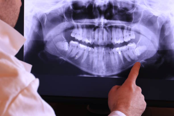 Best Emergency Wisdom Teeth Removal in Johnston, SC