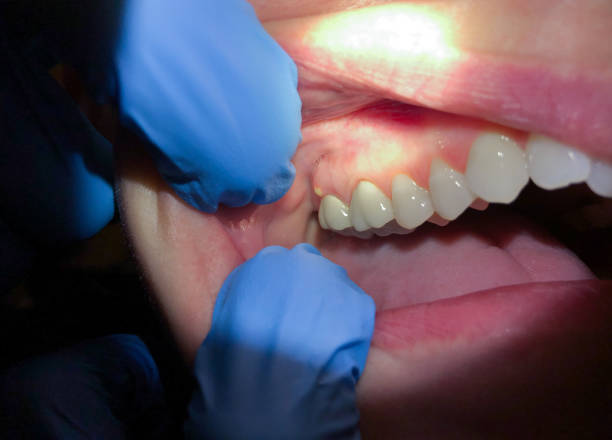 Best Emergency Tooth Extraction in Johnston, SC